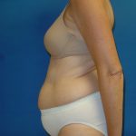 Tummy Tuck Before & After Patient #1779