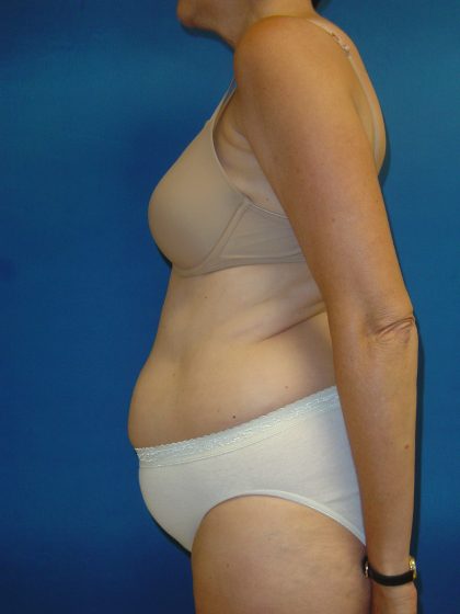 Tummy Tuck Before & After Patient #1779