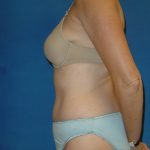 Tummy Tuck Before & After Patient #1779