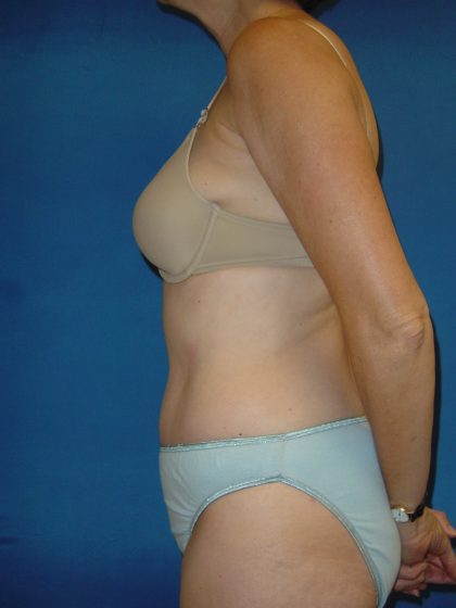 Tummy Tuck Before & After Patient #1779