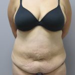 Tummy Tuck Before & After Patient #1778