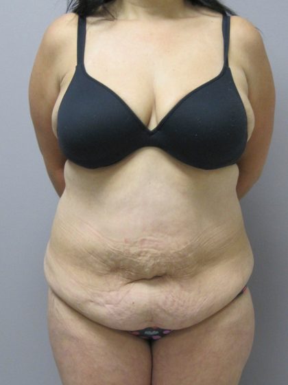 Tummy Tuck Before & After Patient #1778