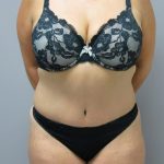 Tummy Tuck Before & After Patient #1778