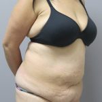 Tummy Tuck Before & After Patient #1778