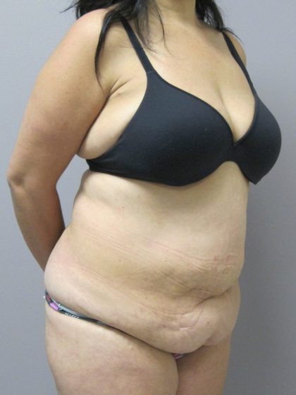 Tummy Tuck Before & After Patient #1778