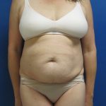 Tummy Tuck Before & After Patient #1777