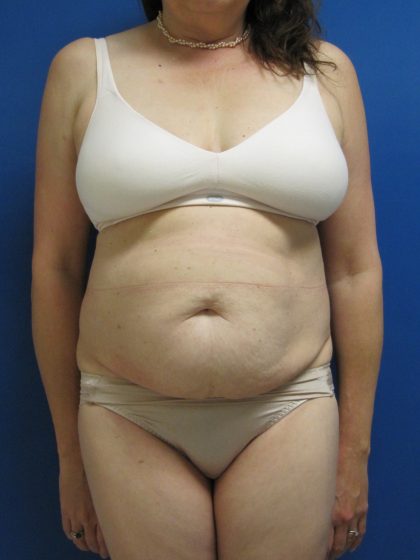 Tummy Tuck Before & After Patient #1777