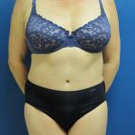 Tummy Tuck Before & After Patient #1777