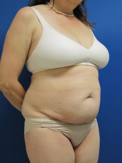 Tummy Tuck Before & After Patient #1777