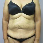 Tummy Tuck Before & After Patient #1776