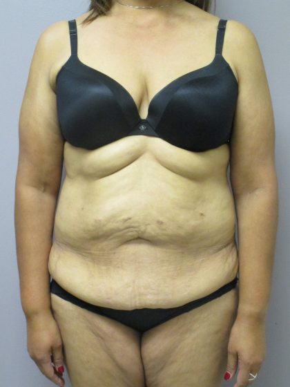 Tummy Tuck Before & After Patient #1776