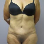 Tummy Tuck Before & After Patient #1776