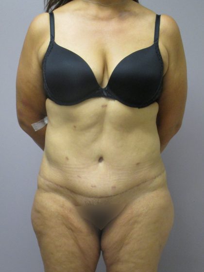 Tummy Tuck Before & After Patient #1776