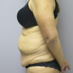 Tummy Tuck Before & After Patient #1776