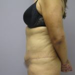 Tummy Tuck Before & After Patient #1776