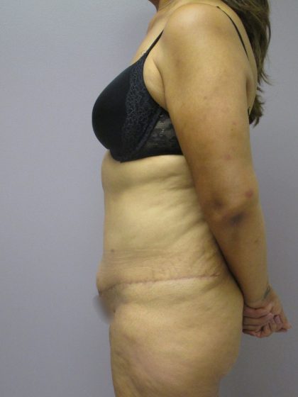 Tummy Tuck Before & After Patient #1776