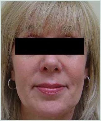 Fillers Before & After Patient #704