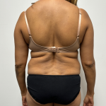 Liposuction Before & After Patient #2286