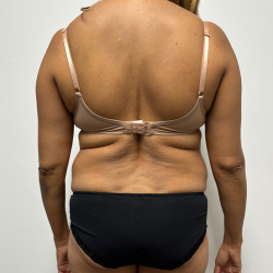 Liposuction Before & After Patient #2286