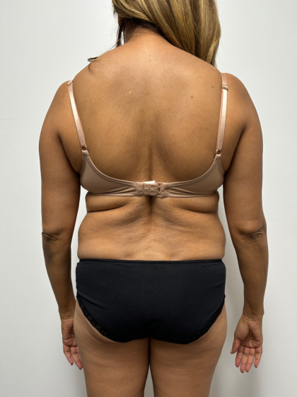 Liposuction Before & After Patient #2286