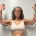 Arm Lift Before & After Patient #2284