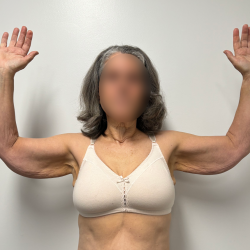 Arm Lift Before & After Patient #2284