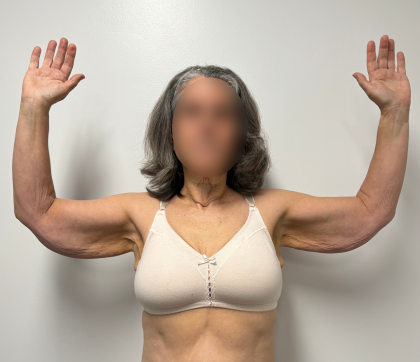 Arm Lift Before & After Patient #2284