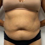 Tummy Tuck Before & After Patient #2289