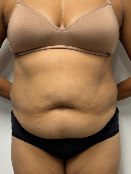 Tummy Tuck Before & After Patient #2289