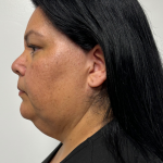 Neck liposuction Before & After Patient #2287