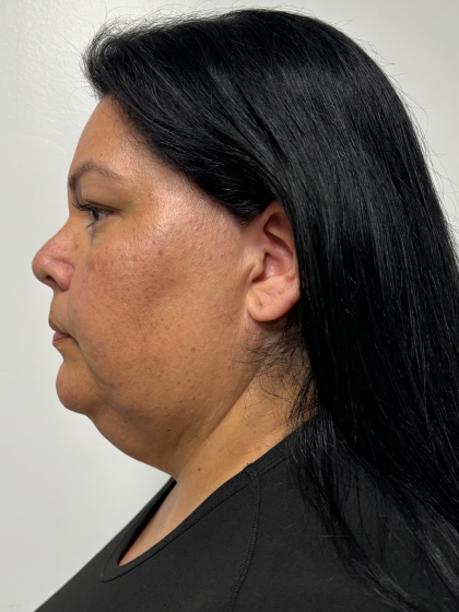 Neck liposuction Before & After Patient #2287