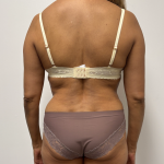 Liposuction Before & After Patient #2286