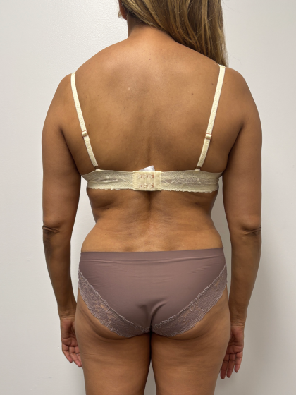 Liposuction Before & After Patient #2286