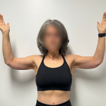 Arm Lift Before & After Patient #2284