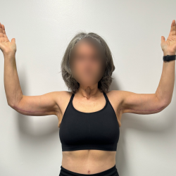 Arm Lift Before & After Patient #2284