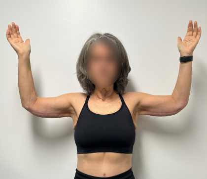 Arm Lift Before & After Patient #2284