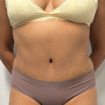 Tummy Tuck Before & After Patient #2289