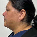 Neck liposuction Before & After Patient #2287
