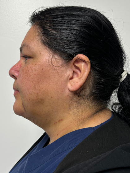 Neck liposuction Before & After Patient #2287