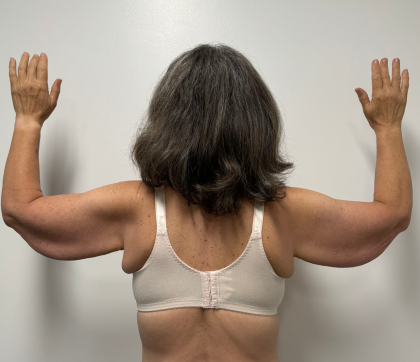 Arm Lift Before & After Patient #2284