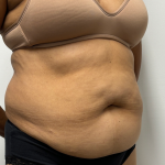 Tummy Tuck Before & After Patient #2289