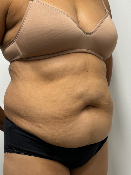 Tummy Tuck Before & After Patient #2289