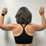 Arm Lift Before & After Patient #2284