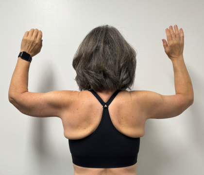 Arm Lift Before & After Patient #2284