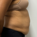 Tummy Tuck Before & After Patient #2289