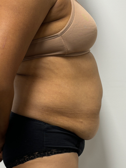 Tummy Tuck Before & After Patient #2289