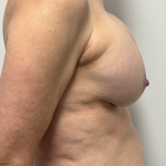 Breast Implant Removal Before & After Patient #2285