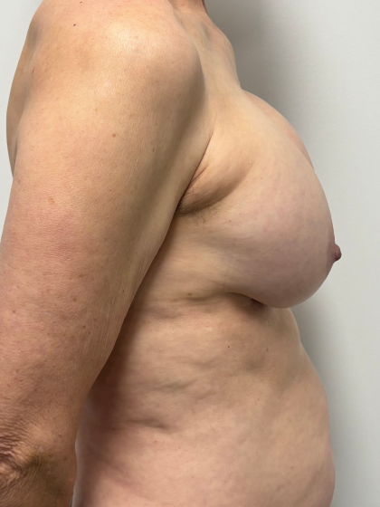 Breast Implant Removal Before & After Patient #2285