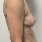 Breast Implant Removal Before & After Patient #2285