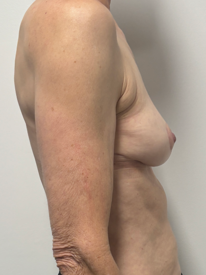 Breast Implant Removal Before & After Patient #2285